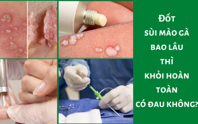 Đốt sùi mào gà bao lâu thì khỏi hoàn toàn, có đau không?