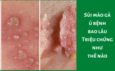 Sùi mào gà ủ bệnh bao lâu – triệu chứng như thế nào