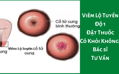 Viêm Lộ Tuyến Độ 1 Đặt Thuốc Có Khỏi Không? – Bác sĩ Tư Vấn