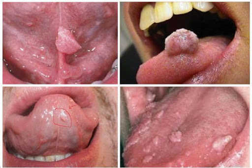 Bệnh sùi mào gà khỏi hẳn hay không phụ thuộc vào tình trạng bệnh 