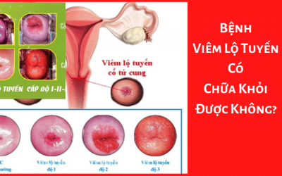 Bệnh Viêm Lộ Tuyến Có Chữa Khỏi Được Không? – Bác Sĩ Tư Vấn