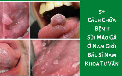 5+ Cách Chữa Bệnh Sùi Mào Gà Ở Nam Giới – Bác Sĩ Nam Khoa Tư Vấn