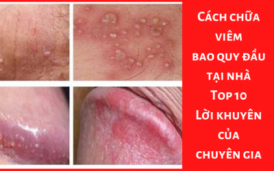 Cách chữa viêm bao quy đầu tại nhà – Top 10 Lời khuyên của chuyên gia