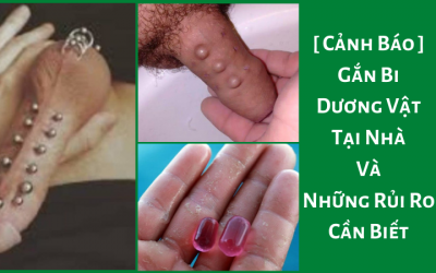 [ Cảnh Báo ] – Gắn Bi Dương Vật Tại Nhà Và Những Rủi Ro Cần Biết