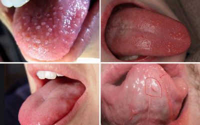 Cảnh báo nguy hiểm khi dưới lưỡi có sợi thịt thừa