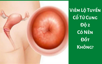 Viêm Lộ Tuyến Cổ Tử Cung Độ 2 Có Nên Đốt Không?