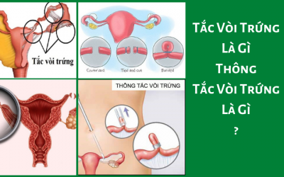 Tắc Vòi Trứng Là Gì, Thông Tắc Vòi Trứng Là Gì?