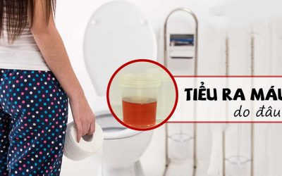 Tiểu Ra Máu Và Hơi Buốt Là Bệnh Gì? – Bác Sĩ Tư Vấn