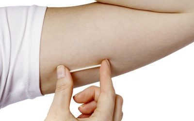 Cấy Que Tránh Thai Bao Nhiêu Tiền? –  Cập Nhật Mới