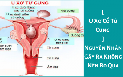[ U Xơ Cổ Tử Cung ] – Nguyên Nhân Gây Ra Không Nên Bỏ Qua