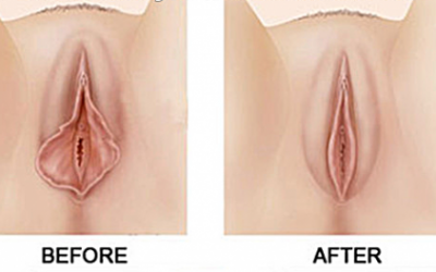 Lợi ích cắt môi bé – Thay đổi diện mạo “cô bé”