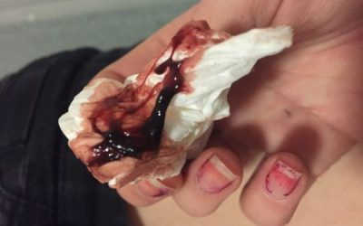 Máu Kinh Ra Nhiều Và Vón Cục Là Bệnh Gì, Có Nguy Hiểm Không?