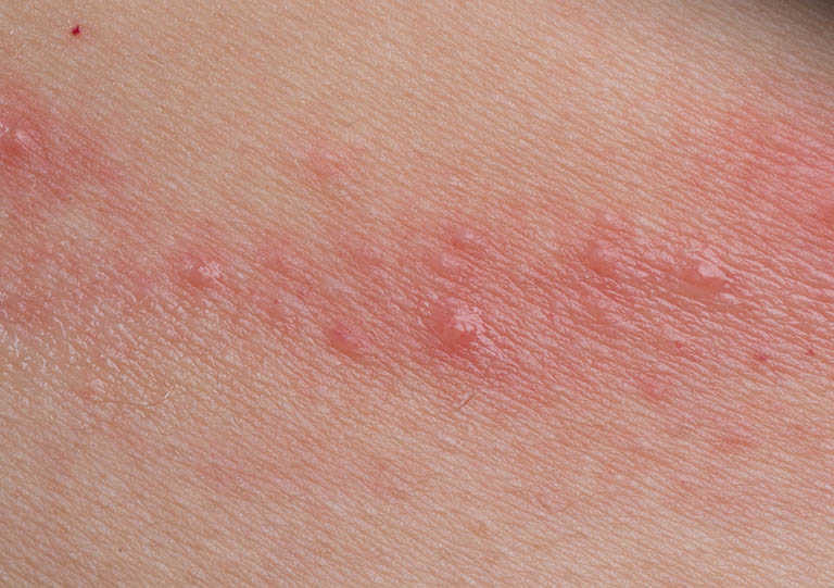 Ngứa vùng kín do viêm da tiếp xúc