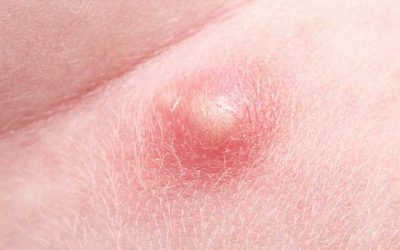 Nổi Mụn Cứng Ở Vùng Kín Nữ Giới Là Bệnh Gì, Có Nguy Hiểm Không?