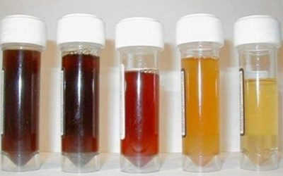 { Nước Tiểu Có Màu Đỏ } – 15 Nguyên Nhân Bất Thường Gây Ra