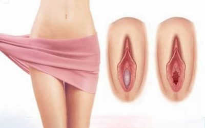 Vá Màng Trinh Và Lưu Ý Sau Khi Vá Màng Trinh Cần Kiêng Gì?