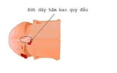 Đứt Dây Hãm Bao Quy Đầu Có Sao Không?