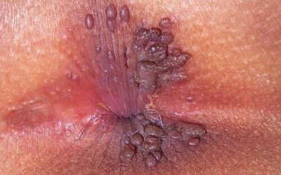 Hậu Môn Có Thịt Dư Là Bệnh Gì? Có Nguy Hiểm Không?