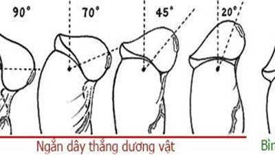 Nam Giới Có Nên Cắt Dây Hãm Bao Quy Đầu Không?