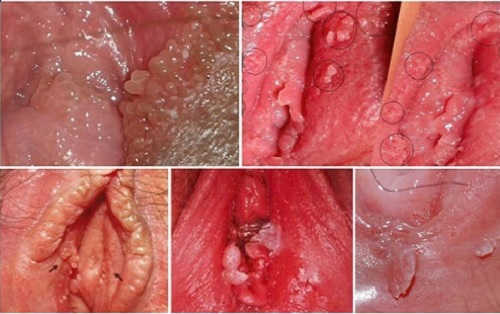 Nổi cục ở môi lớn