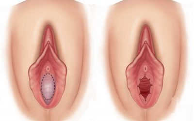 Màng trinh có dễ rách không? Nhận biết màng trinh còn hay rách chính xác