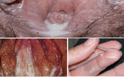 Xét Nghiệm Bệnh Lậu Ở Đâu? – 3 Địa Chỉ Điều Trị Bệnh Lậu Tại Hà Nội