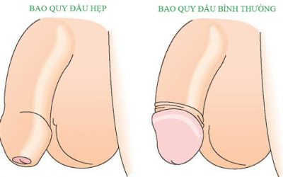 [ Cảnh Báo ] Nguy Hiểm Khi Cắt Bao Quy Đầu Bị Chảy Mủ