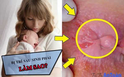 [Tổng hợp] Cách chữa bệnh trĩ cho phụ nữ sau sinh hiệu quả nhất