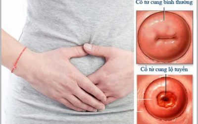 Tìm hiểu phương pháp chữa viêm lộ tuyến tại bệnh viện phụ sản Hà Nội