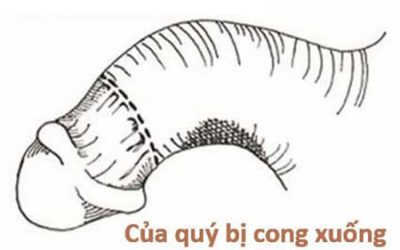 Tại sao nam giới xuất hiện tình trạng dương vật cong xuống?