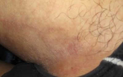 Nấm vùng kín nam giới: Dấu hiệu nhận biết & nguy cơ lây nhiễm