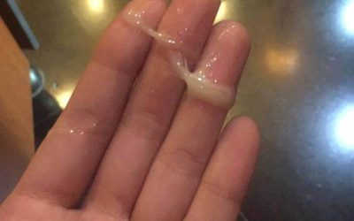 Tinh trùng vón cục màu vàng là bệnh gì? Điều trị tại nhà có tốt?