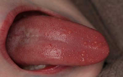 [Giải đáp] Tại sao nổi hột đỏ ở cuống lưỡi, có nguy hiểm không?