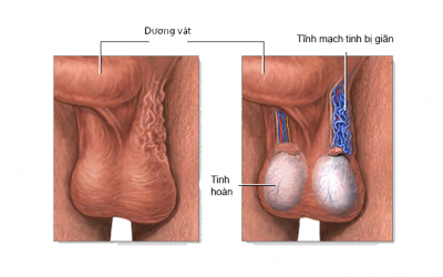 Mổ giãn tĩnh mạch thừng tinh bao nhiêu tiền?