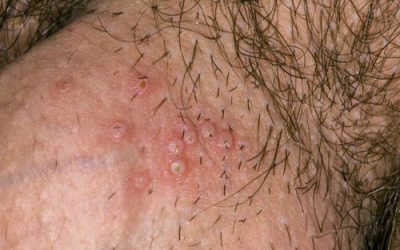 Mọc mụn ở bìu cơ quan sinh dục nam cảnh báo dấu hiệu nguy hiểm