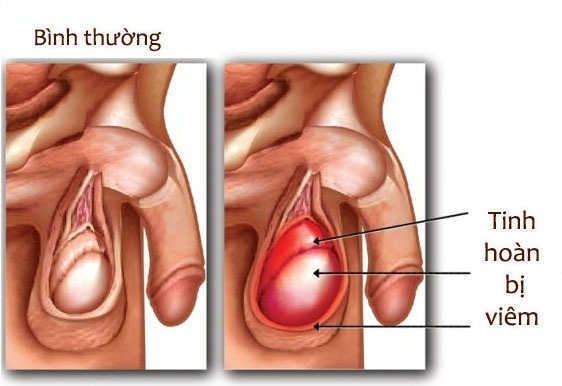 Chữa viêm tinh hoàn cần chú ý những gì?