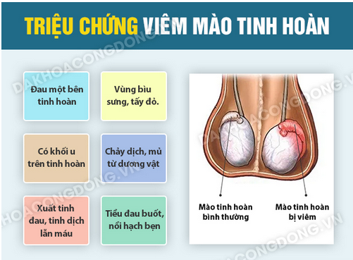 Triệu chứng nhận biết bệnh viêm mào tinh hoàn