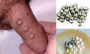 Chi phí gắn bi cho nam giới bao nhiêu tiền? [Bảng giá chi tiết từng hạng mục]