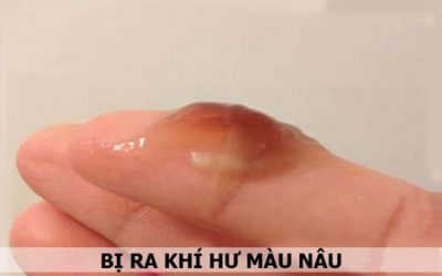 Khí hư màu nâu giữa kỳ kinh là bệnh gì, nguy hiểm không?