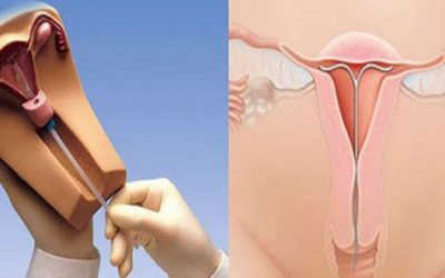 Sau khi đặt vòng bị ra khí hư: Nguyên nhân và cách xử lý