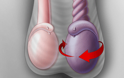 Đau tinh hoàn bên trái là bệnh gì [8 bệnh lý nguy hiểm]