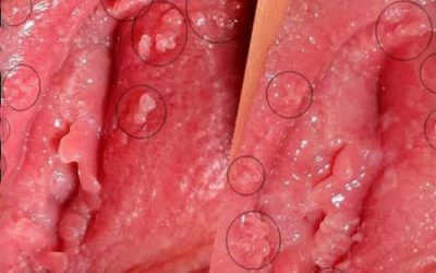 Nổi cục thịt ở vùng kín nữ: Nguyên nhân và cách điều trị