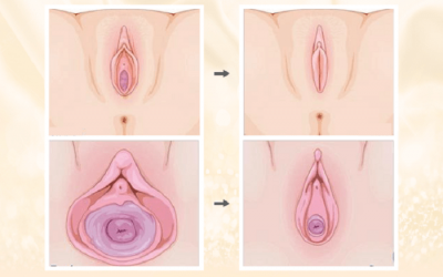 Phẫu thuật se khít vùng kín bao nhiêu tiền? Địa chỉ phẫu thuật uy tín