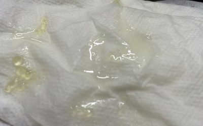 Cảnh báo vô sinh ở nam giới khi tinh trùng có hạt trắng như thạch