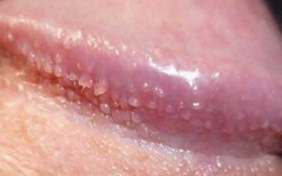 Bao quy đầu xuất hiện đốm trắng – Dấu hiệu cảnh báo bệnh nguy hiểm