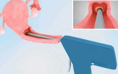 [ REVIEW ] Chữa viêm lộ tuyến bằng áp lạnh có hiệu quả không?