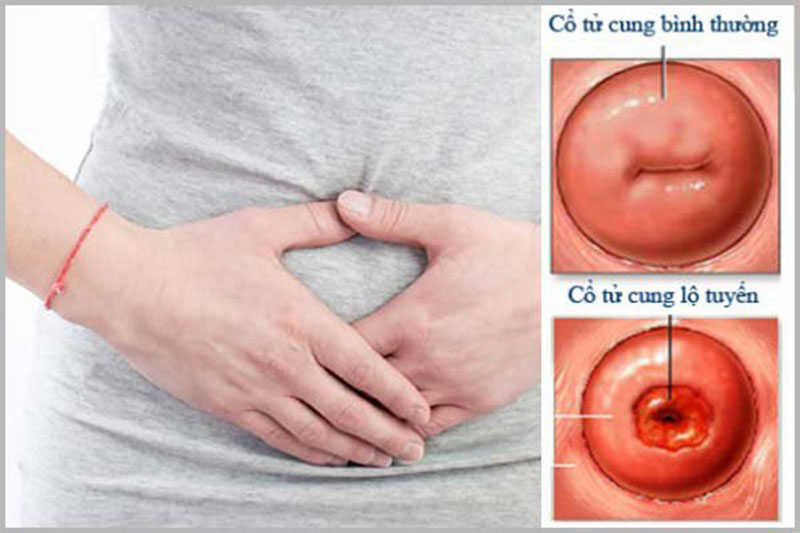 Những triệu chứng của viêm lộ tuyến độ 4